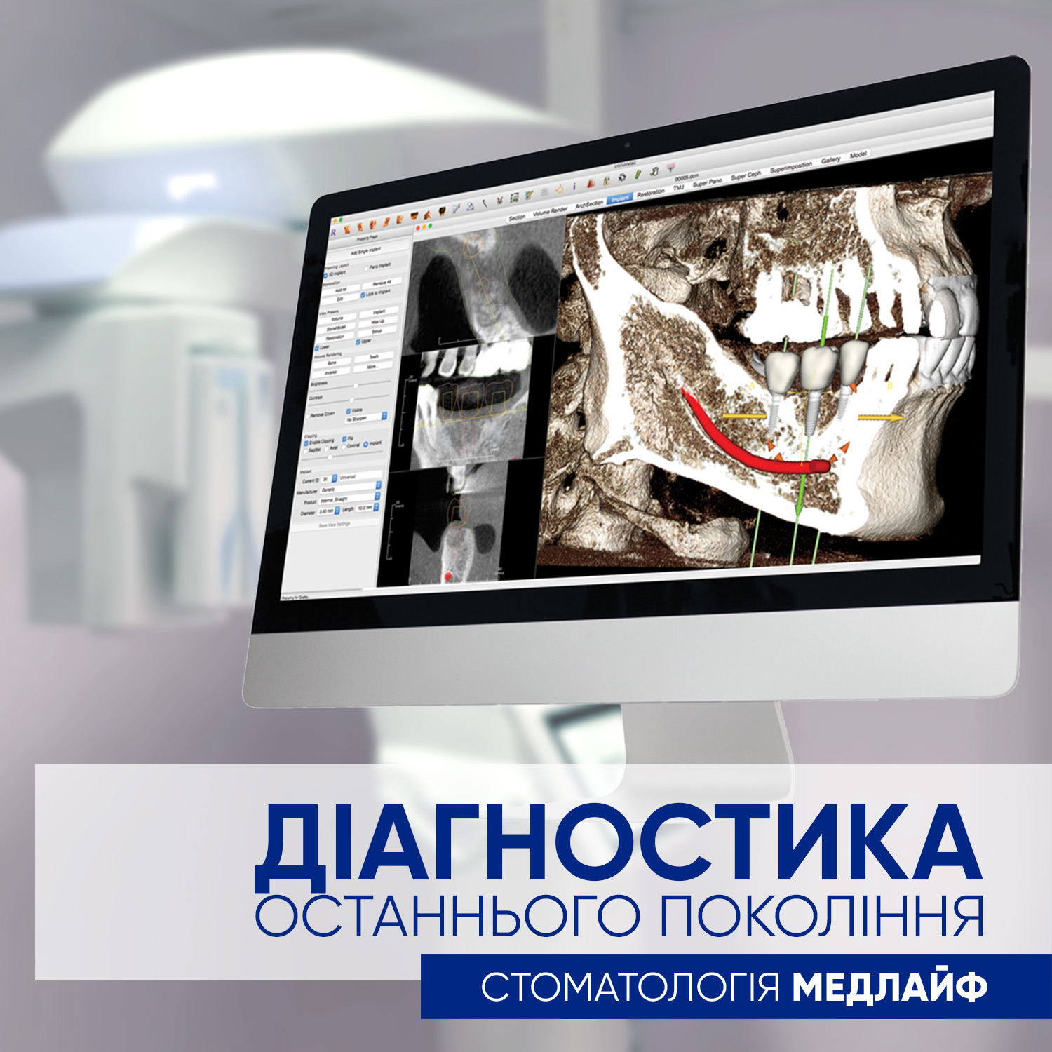 Комп’ютерний томограф MyRay Hyperion X9 Pro – рентгенологічне устаткування останнього покоління