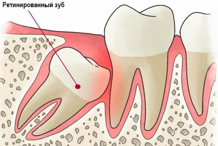 Что такое - ретинированный зуб? 